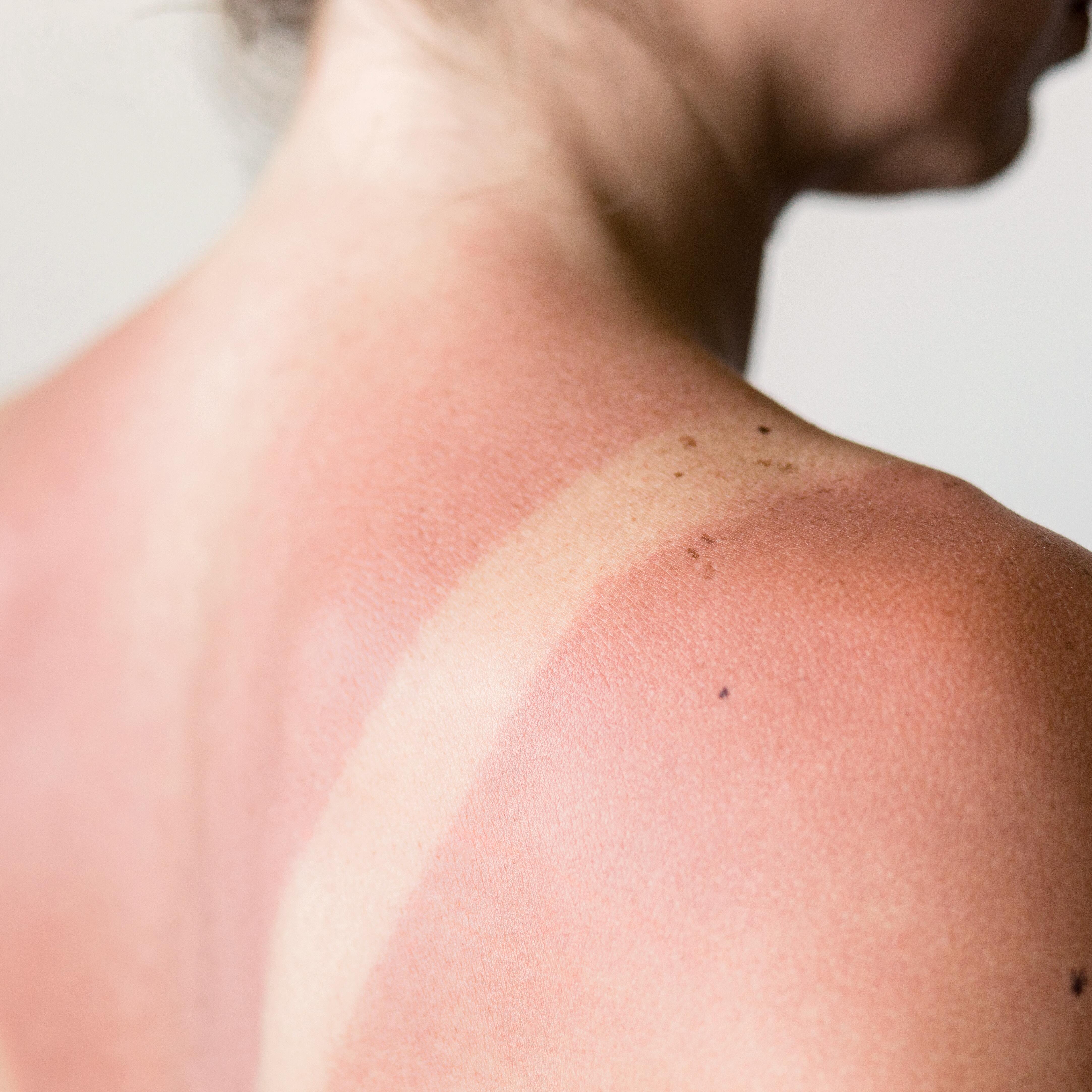 Solbrændt hud forårsaget af solens UV-stråler